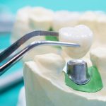 The process of making dental crowns